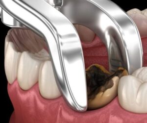 القلع الجراحي وزراعة الأسنان